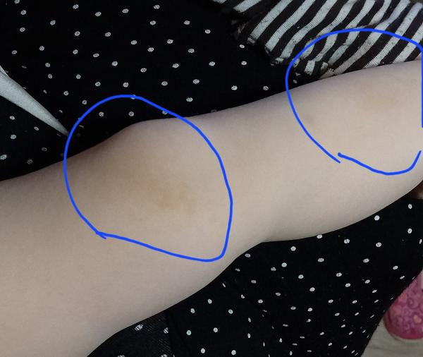 Neurofibromatóza. Je důvod k obavám? Jaká vyšetření jsou vhodná?