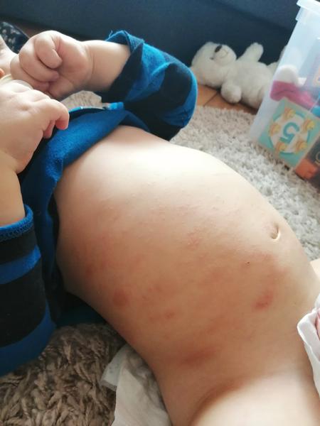 Co to může být, ekzém?