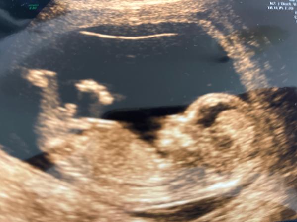 Lze určit pohlaví miminka z ultrazvukového snímku?