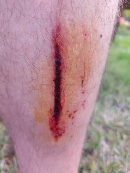 Jak zmírnit otok a zánět po úrazu?