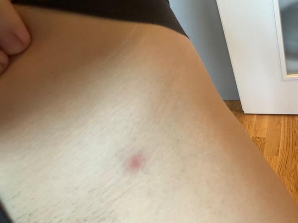 Mohou být pupínky příznakem neštovic během těhotenství?