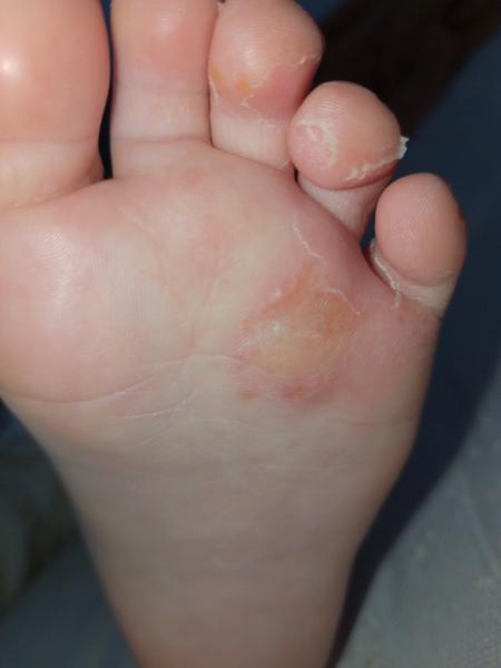 Vyrážky na noze dítěte. Co může být příčinou a jak léčit?