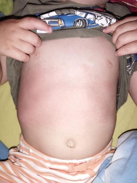 Vyrážka a teplota. Poradíte, prosím?