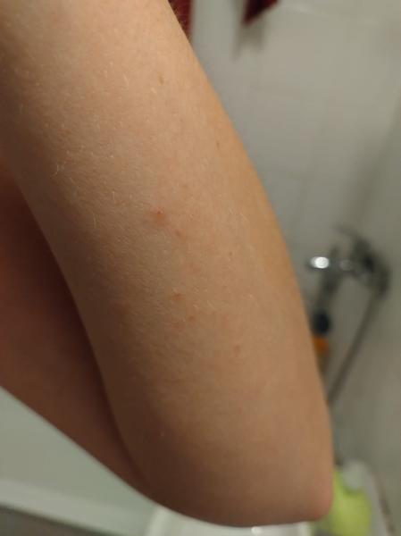 Pupínky na zápěstí. Je to alergie nebo svrab?