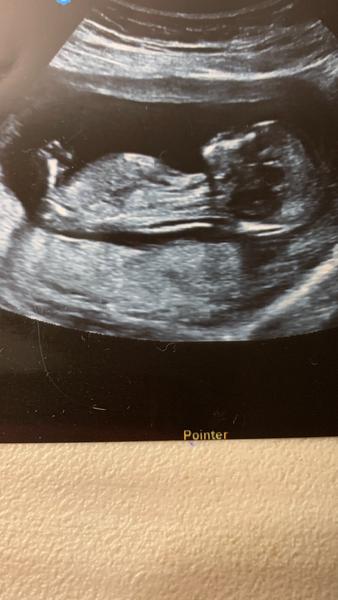 Ultrazvuk. Je to chlapeček?