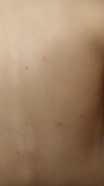 Rozpoznání vyrážky u dětí: Neštovice nebo štípnutí hmyzem?