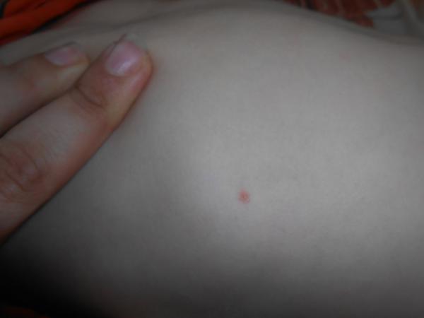 Co to je za pupínky?