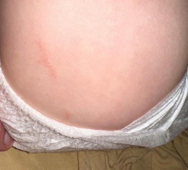 Co má syn na noze a proč se to zvětšuje?