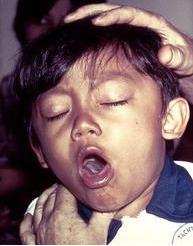 Akutní epiglotitida Akutní epiglotitida