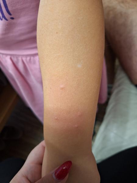 Kožní vyrážka na rukách a nožkách: Co to může být?