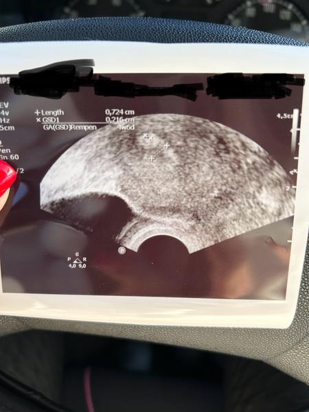 Těhotenství 4+4 týdny a 2 mm: Je to normální?