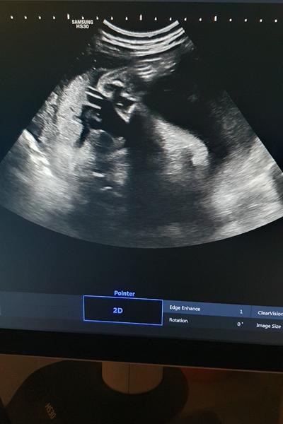 Pohlaví miminka: Jaké pohlaví je na ultrazvuku?