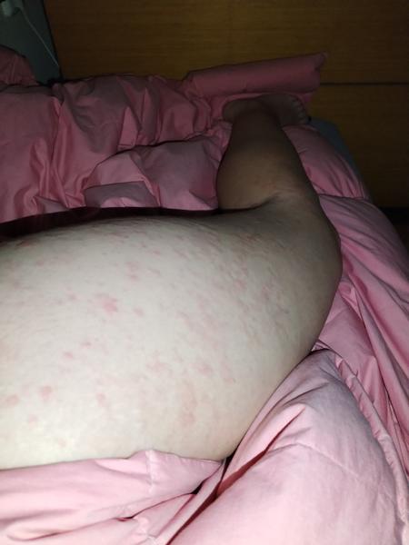 Dlouhotrvající svědivá vyrážka: Jaké jsou vaše zkušenosti?