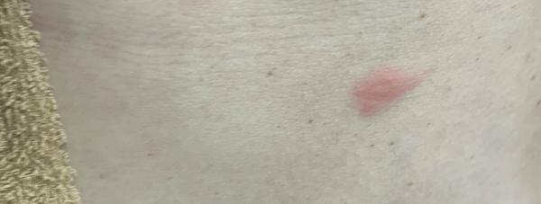 Může být pásový opar bez bolesti a svědění?