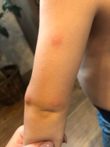 Fleky na kůži u dětí. Mohou to být neštovice?