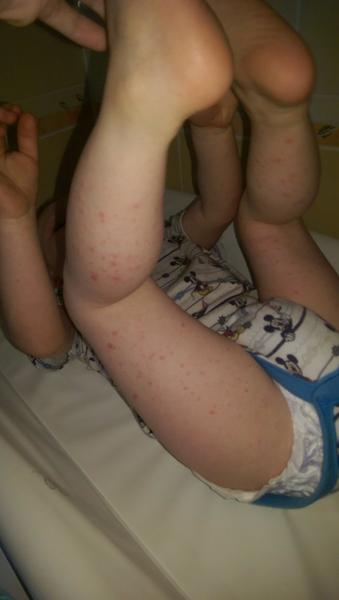 Teploty a vyrážka u 20měsíčního syna