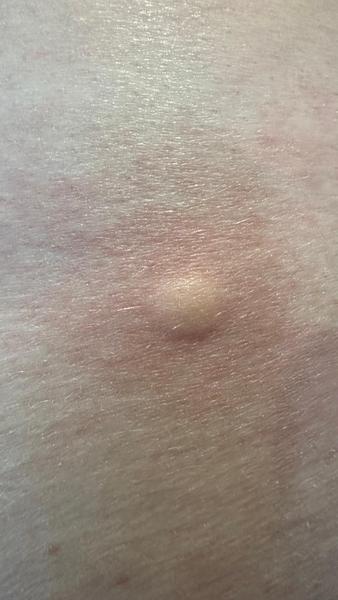 Štípanec nad zadkem: Co to mohlo způsobit?