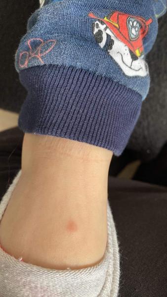 Pupínky už 3 týdny beze změny. Co by to mohlo být?