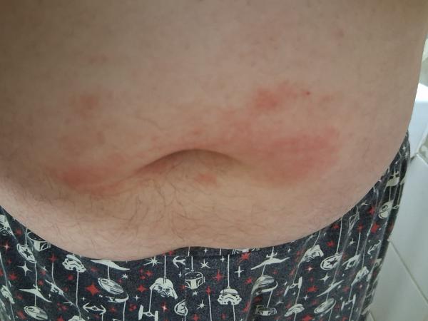 Vyrážka u dospívajícího syna. Může to být svrab?