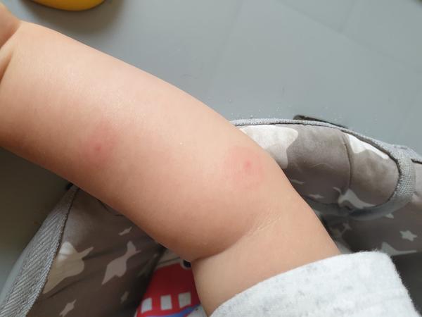 Plané neštovice nebo bodnutí hmyzem. Co by to mohlo být?