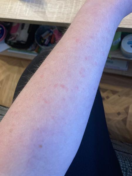 Horečka a vyrážka po porodu. Jaké mohou být příčiny?