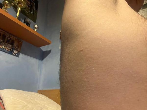 Svědění a pupínky po těle. Může to být svrab?