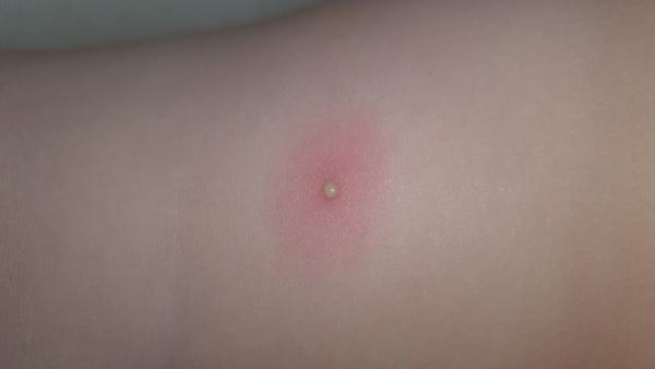 Vyrážka, infekce nebo neštovice. Poradíte, prosím, co by to mohlo být?