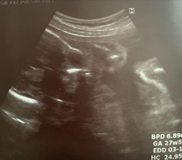 Dlouhá lebka miminka. Jde poznat kraniosynostóza z UTZ?