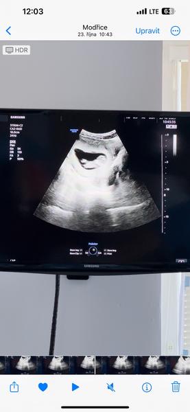 Pohlaví dítěte. Lze určit?