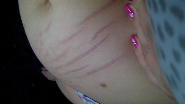 Strašné strie, jak je teď ošetřovat?