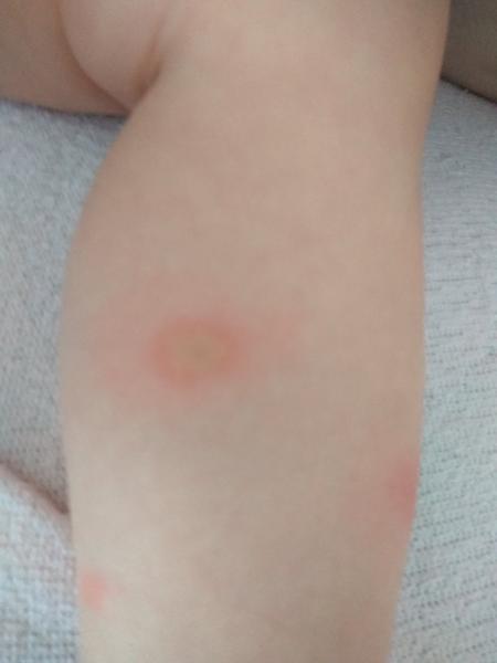 Štípance jen u dcery. Poznáte, o co by mohlo jít?