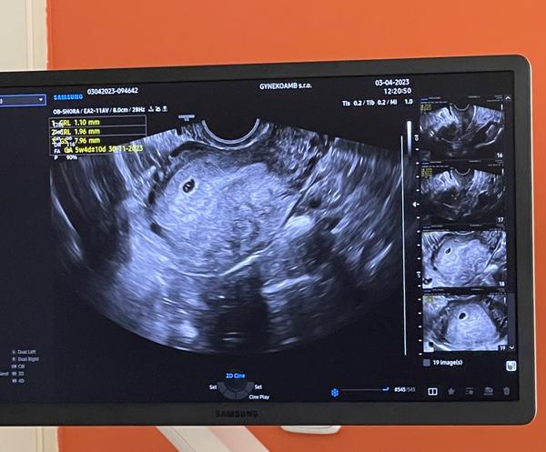 5. týden těhotenství. Je to v pořádku?