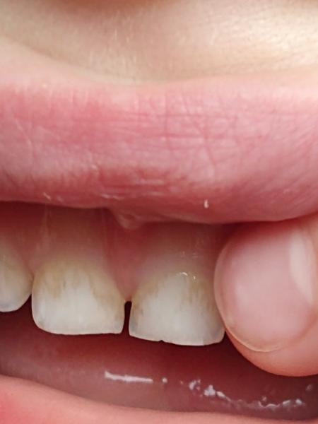 Fleky na zubech u pětiletého dítěte. Jak řešit?