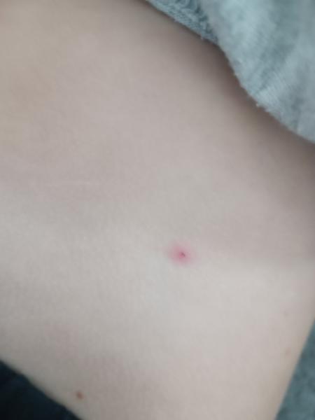 Jsou tyto pupínky příznakem neštovic?