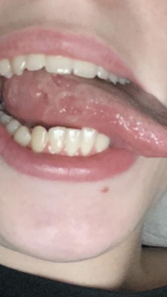 Fleky na jazyku. Jaký je na to Váš názor? Co by to mohlo být a co by mohlo pomoci?