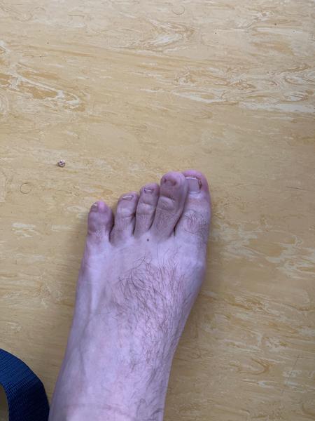 Jak se zbavit bolesti u hallux valgus po operaci?