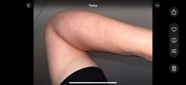 Vyrážka. Co to může být a jak to léčit?