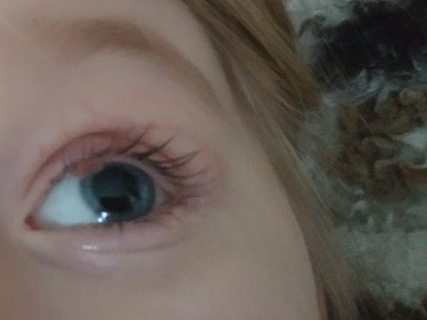 Chalazion a conjunctivitis subac. Visící kůžička. Ztratí se to samo, případně, co s tím?