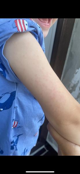 Máte zkušenosti s červenými uši, tvářemi a vyrážkou?