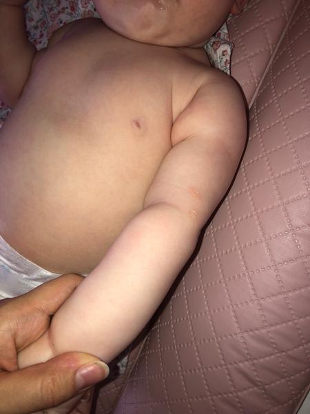 Suché fleky kolem loktů u dcery - co může být příčinou?