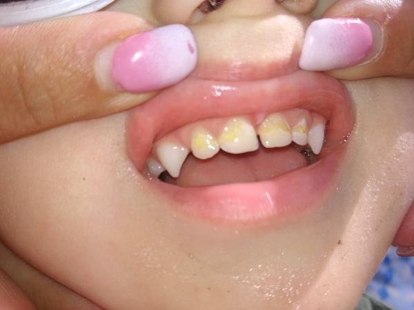 Medové zoubky - jak na zubaře, když malý hrozně pláče?