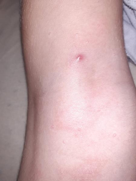 Pupínky na noze u dcery. Co to může být?