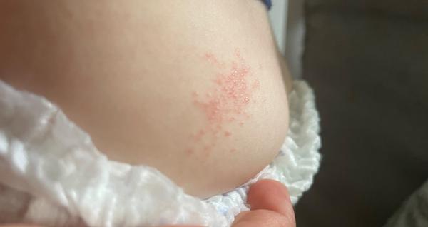 Příčiny vyrážky u dětí z pleny. Co dělat?