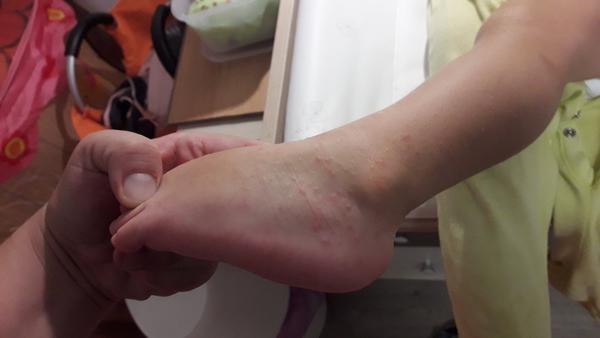 Vyrážka nebo ekzém. Poradíte, prosím, co by to mohlo být?