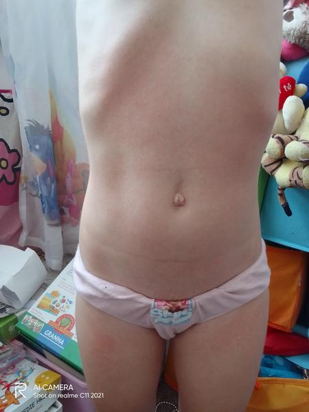 Co způsobuje vyrážku doprovázenou vysokou teplotou u dětí?