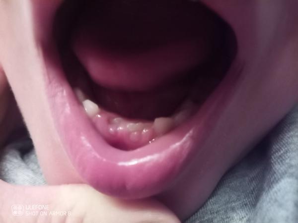 Růst druhých zubů. Srovná se to? Máme řešit?