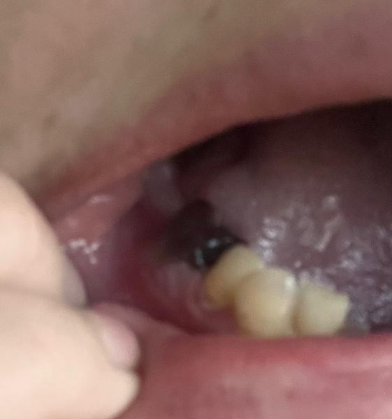 Je normální, že sraženina po vytržení zubu vypadá obří?