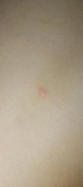 Pupínky na zádech u dítěte: Co to může znamenat?