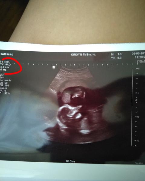 Vysvětlivky na fotce ultrazvuku