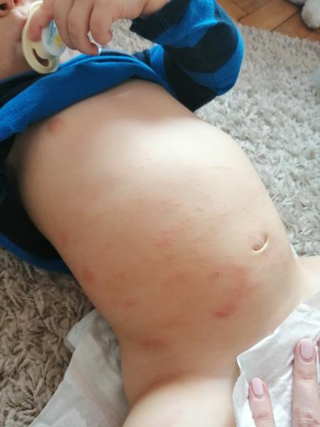 Co to může být, ekzém?